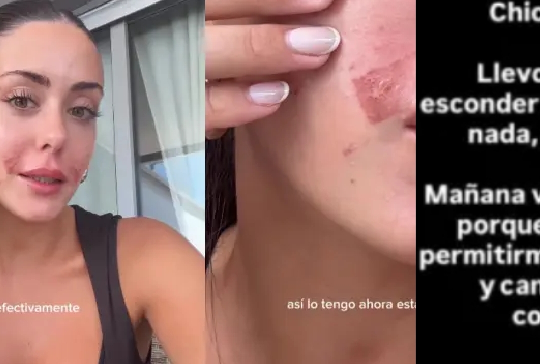 Rosario de LIDLT reaparece con el rostro totalmente abrasado «Me iba a esconder bajo una piedra»